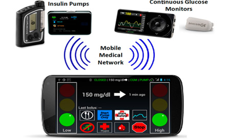 El pancreas artificial